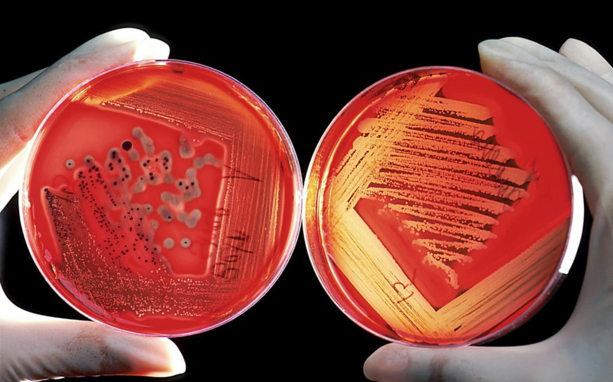 Der unsichtbare Schuldige: Porphyromonas gingivalis verstehen